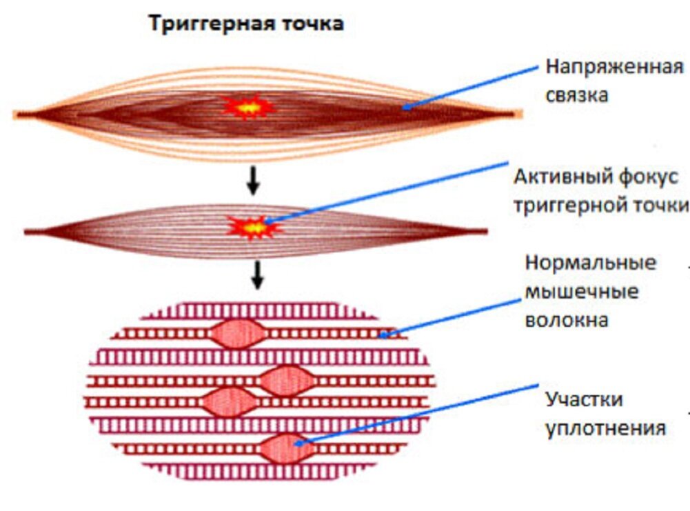 Триггерные точки прямой мышцы живота