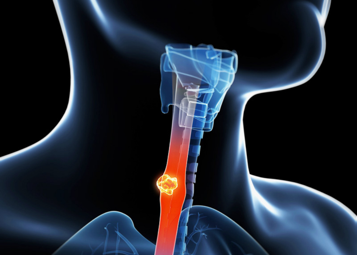 Ощущение глотания. Злокачественные новообразования пищевода. Боли в гортани и пищеводе. Пищеводная дисфагия снимки.