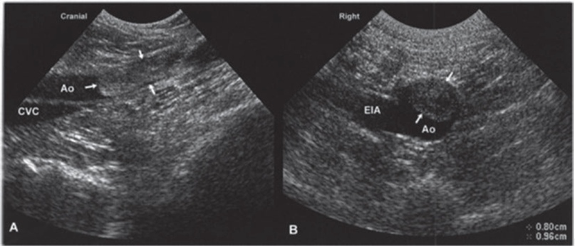 Рис. 1. Тромбоэмболия аорты. Изображение каудальной части брюшной аорты (Ао) собаки со слабостью тазовых конечностей, полученноев продольной (А) и поперечной (В) проекциях. В просвете аорты визуализируется эхогенная трубчатая структура с относительно четкимиграницами, которая вызвала окклюзию большей части просвета сосуда и является эмболом (показан стрелками). У собаки был диагности-рован гиперадренокортицизм, который мог являться предрасполагающим фактором для формирования тромбов. CVC - каудальная полаявена; EIA - наружная подвздошная артерия