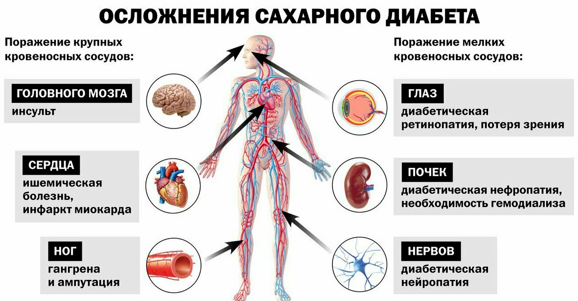 Хронические осложнения СД. Осложнения СД 1 типа и 2 типа. Диабетические осложнения 1 типа. Осложнения сахарного диабета 2 типа.