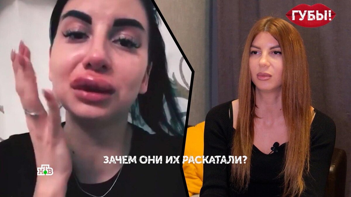    После посещения    косметолога-гастролера    губа россиянки увеличилась на 6 см