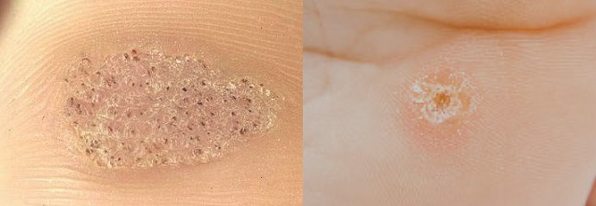 Слева – подошвенная бородавка. Справа – стержневая мозоль