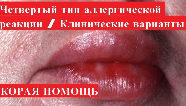 Внимание!Вся информация в видео только для ознакомительных целей!При возникновении каких либо симптомов вызывается скорая медицинская помощь! 