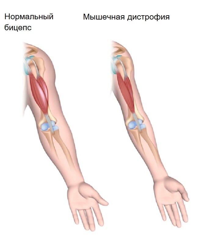 Также различают детскую и юношескую формы.