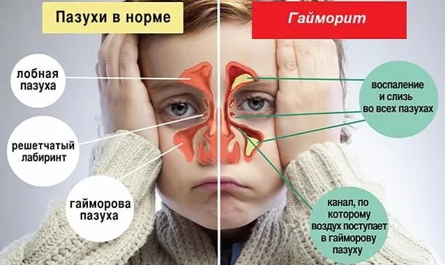 Повышение внутричерепного давления