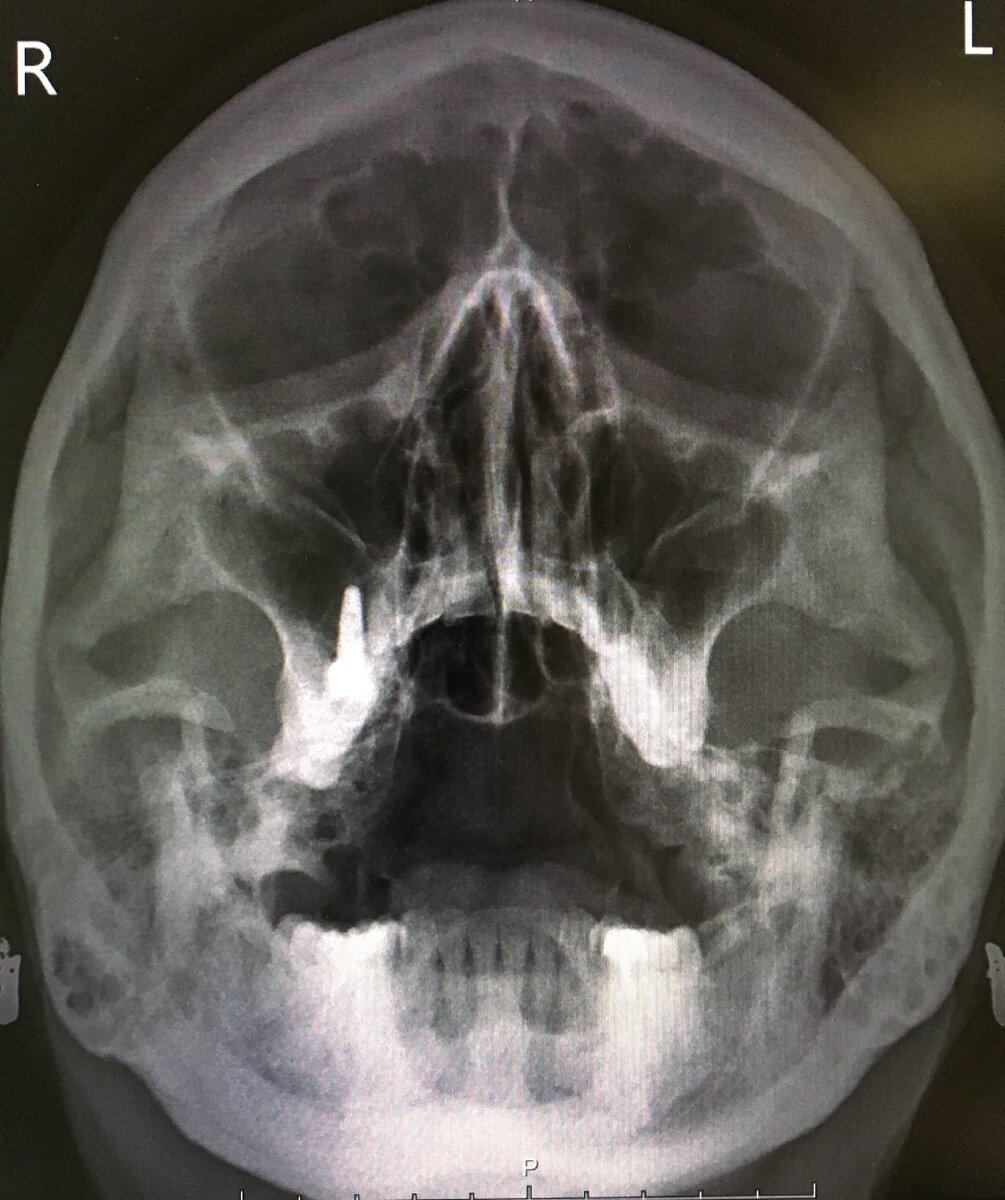 Снимок гайморовых пазух: КТ или рентген?​ – ЛенТомограф