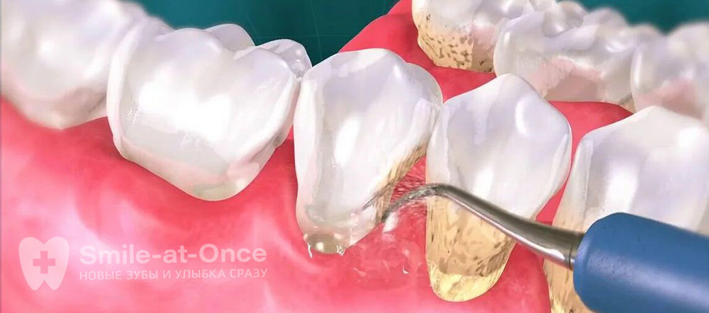 Что такое SPA для зубов и кто такой стоматолог-гигиенист? | Стоматология  Smile-at-Once | Дзен