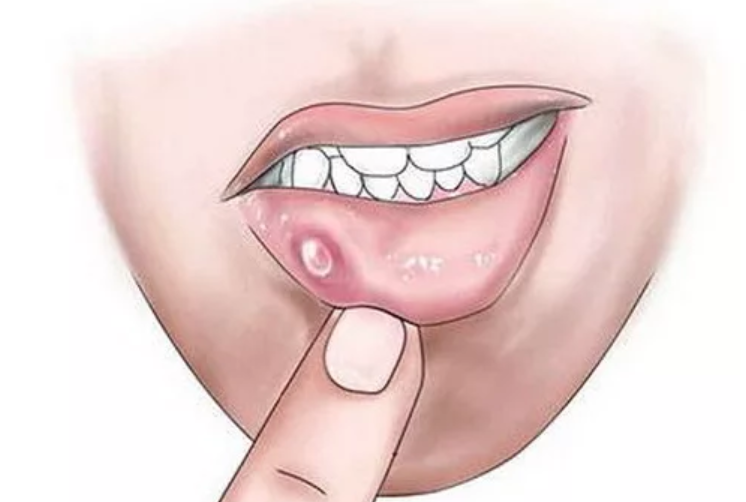 Лечение воспаления слюнных желез в стоматологии АО «Медицина» (клиника академика Ройтберга)