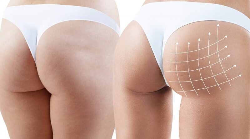 На сегодняшний день, данная операция по увеличению ягодиц, является достаточно популярной. Особенно среди женщин после 30, которые хотят скорректировать свою фигуру. Процедура имплантации силиконового имплантата в ягодицы, пользуется все большим спросом среди женщин. Среди его многочисленных преимуществ, процедура увеличивает и формирует область регулярным и естественным образом, оставляя небольшие следы. Показана людям с маленькими приплюснутыми ягодицами или тем, кто хочет моделировать эту область. Эта процедура имеет множество преимуществ, о которых и пойдет дальше речь.