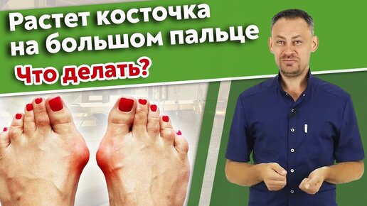 Hallux valgus. Почему торчат косточки на пальцах ног?