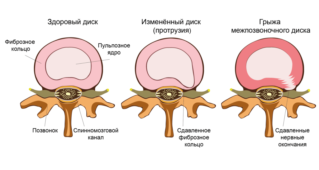 Образование грыжи