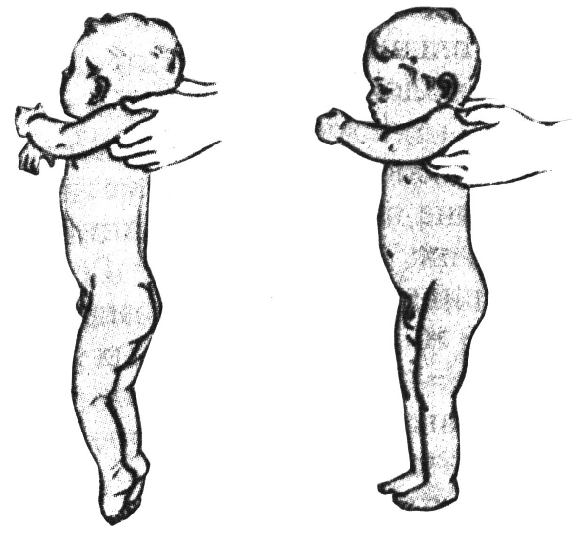 Рефлекс паралича. Рефлекс автоматической походки у новорожденных. Рефлекс опоры новорожденного. Рефлекс опоры и автоматическая походка новорождённых.