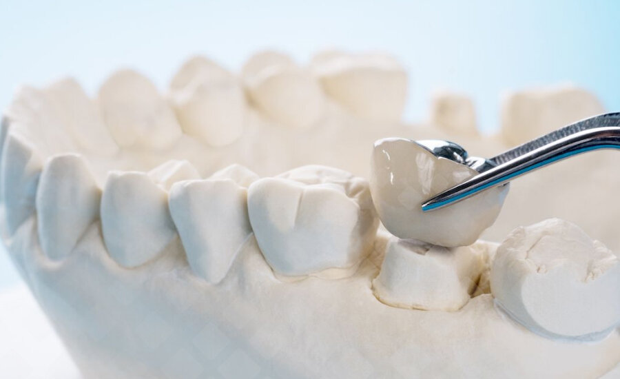 Зубные коронки – популярный и наиболее оптимальный вариант восстановить полуразрушенный зуб. Фото: Яндекс.Картинки.