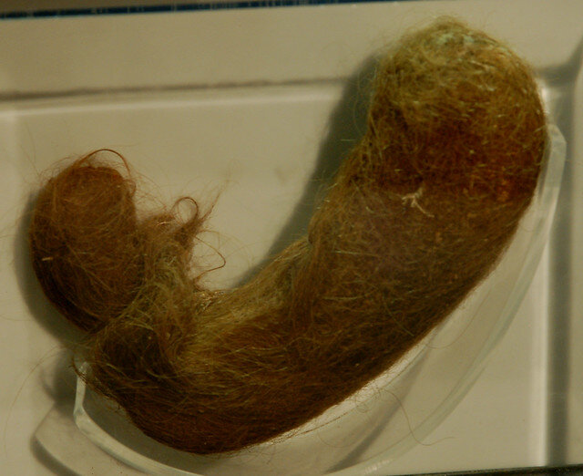 Трихобезоар.  Источник: https://clck.ru/sFGPt