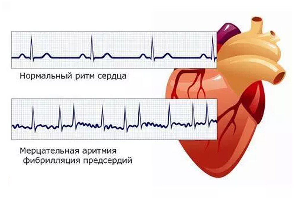 Аритмия и как понять, что она у вас есть | Тюменский кардиоцентр | Дзен