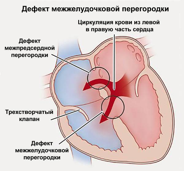 Дмжп у плода