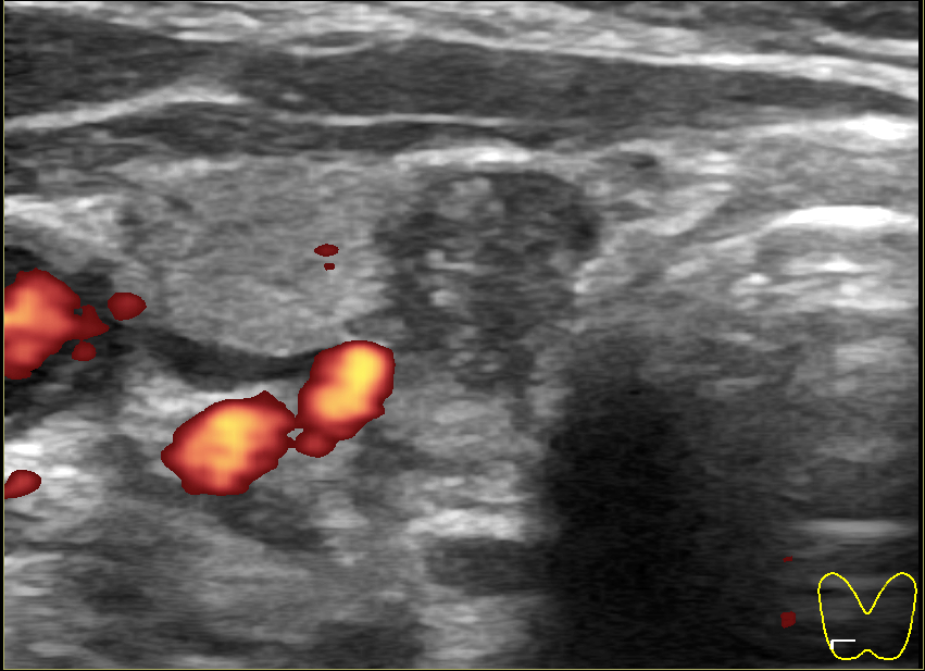 Щитовидная железа узлы в правой доле. Щитовидная железа 2 узла. Узел щитовидной железы 7х6х8. Узел в перешейке щитовидной железы.