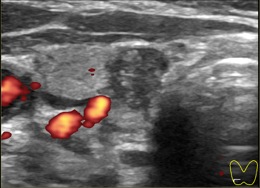 Узел щитовидной железы что это. Гипоэхогенный узел щитовидной железы что это такое. Спонгиозный узел щитовидной железы. Кистообразный узел щитовидной железы. Узел щитовидной железы 7х6х8.
