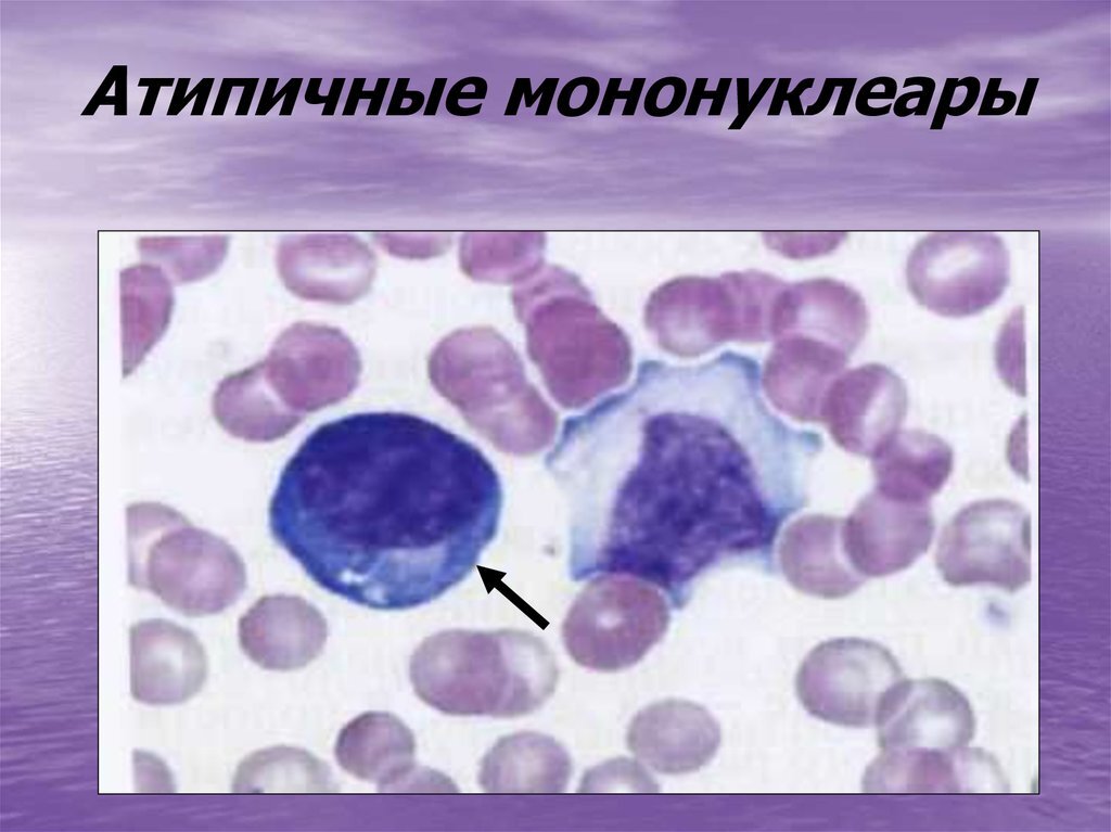 Атипичные мононуклеары картинки