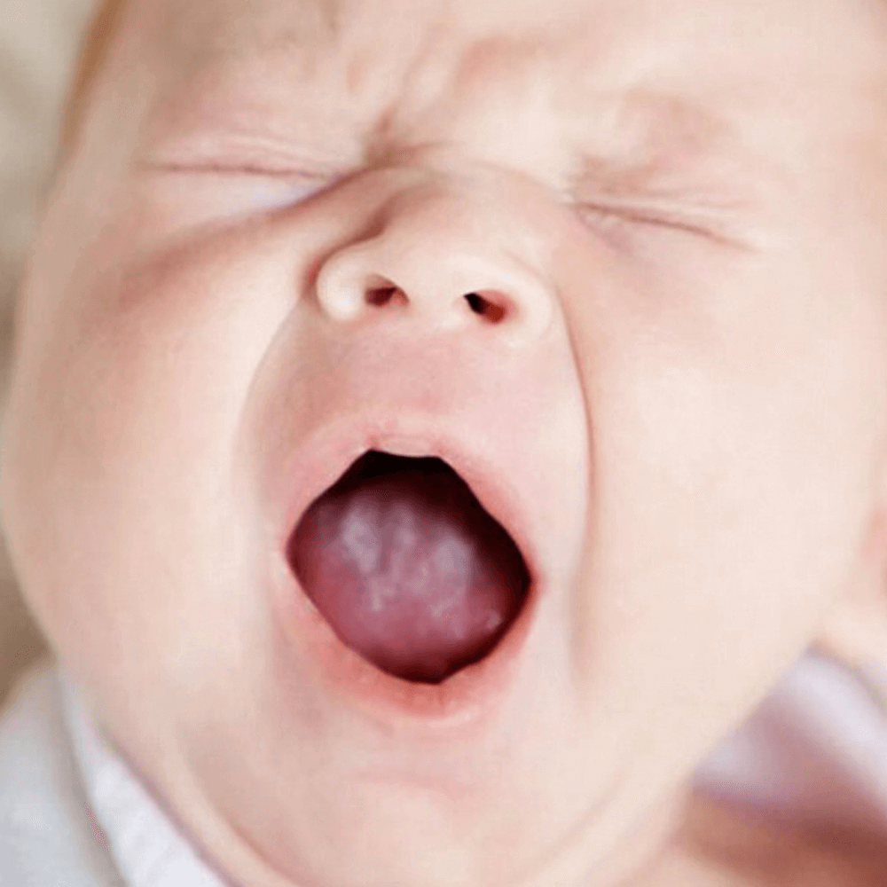 Молочница у детей во рту: симптомы, причины, лечение и профилактика