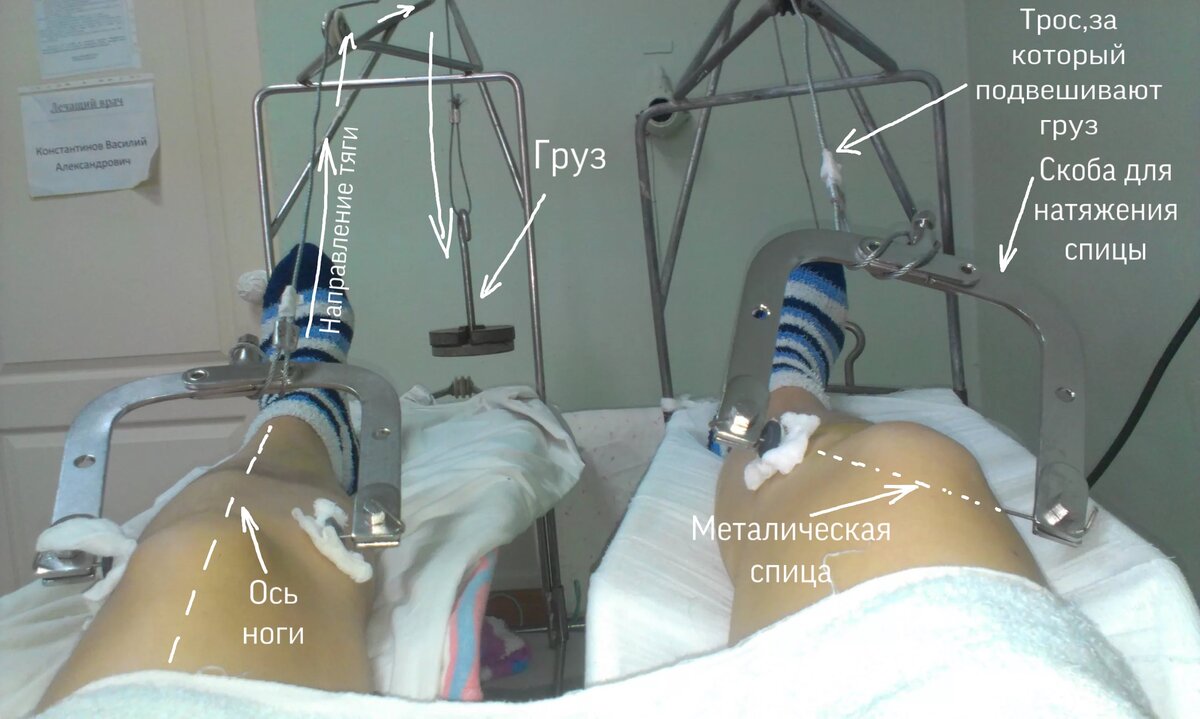 Скелетное вытяжение лечение. Перелом бедра скелетное вытяжение. Скелетное вытяжение при переломе голени.