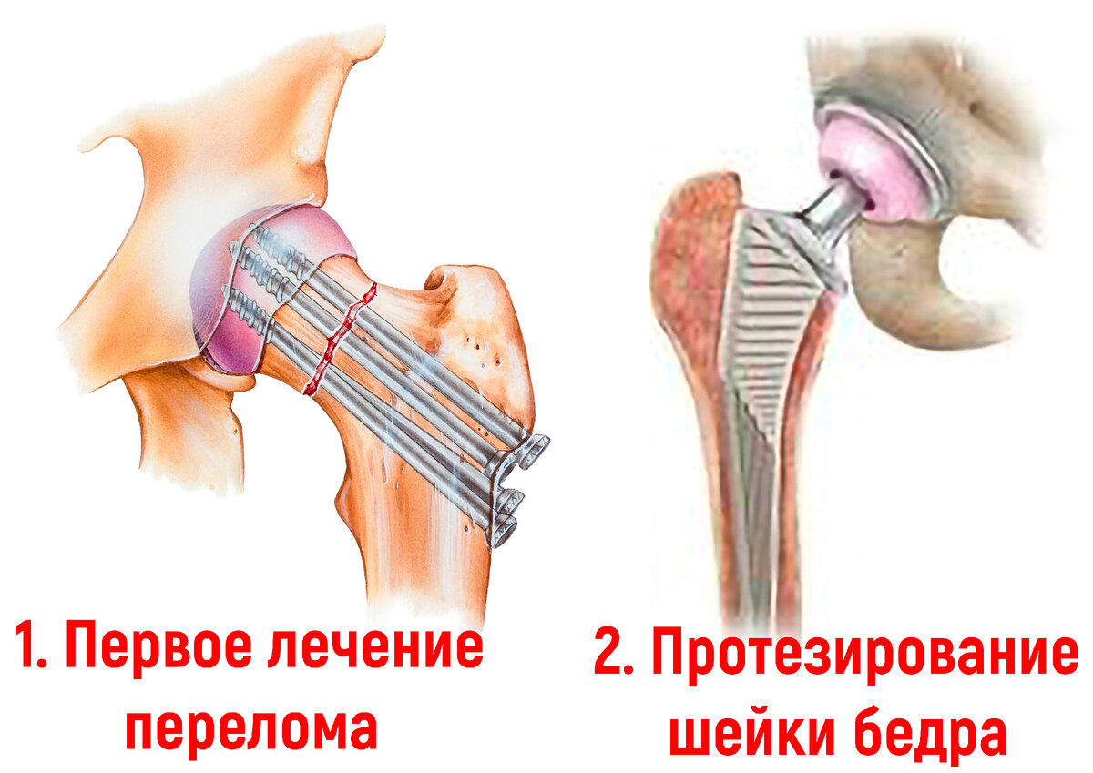 Перелом шейки бедра лечение