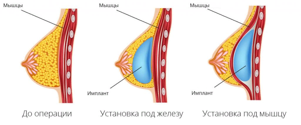 Грудь разного размера — причины и как исправить асимметрию груди в «СМ-Пластика»