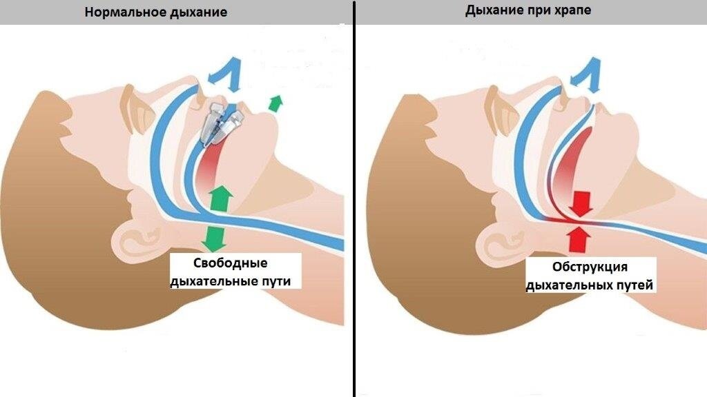 Когда ребенок начинает дышать ртом. Храпят ли астматики.