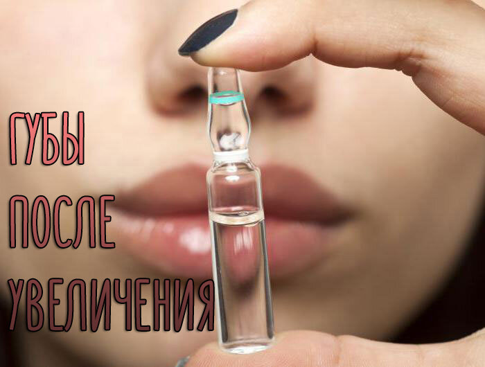 Рекомендации перед увеличением губ гиалуроновой кислотой