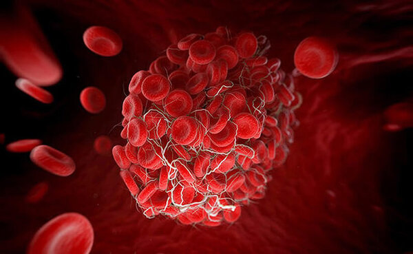 5 сгущающих кровь лекарств, которые могуть стать причиной образования тромба