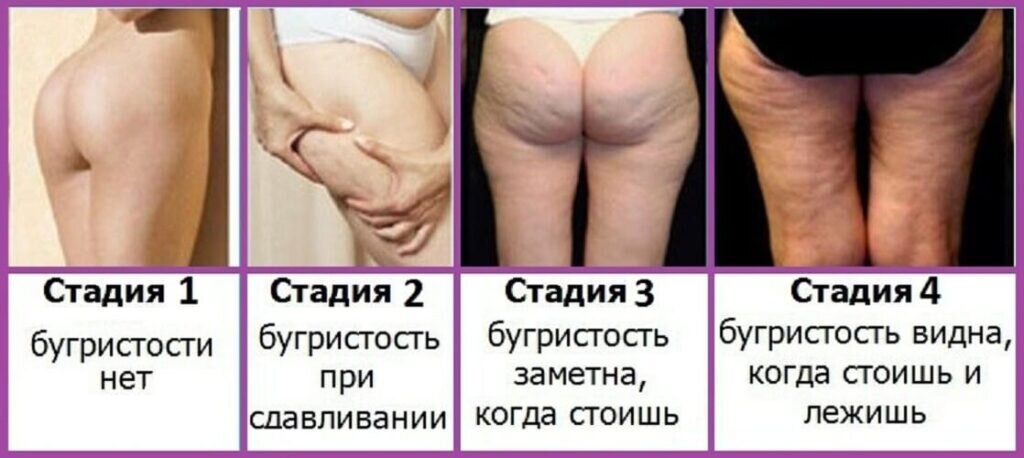 4 стадия целлюлита фото Немного об антицеллюлитном массаже Дзен о здоровье и питании Дзен