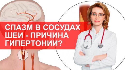 Причина гипертонии - спазм в сосудах шеи? Мнение кардиолога