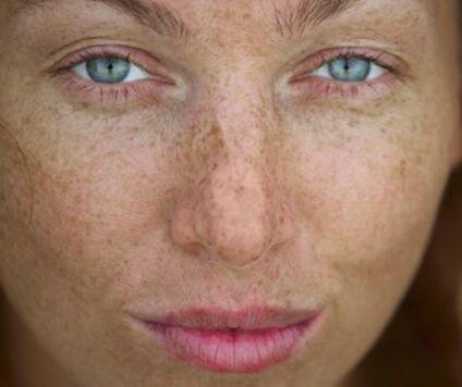 Лицо загорело пятнами. Лицо загорело пятнами. Лицо загорело пятнами. Гиперпигментация на лице. Лицо загорело пятнами.