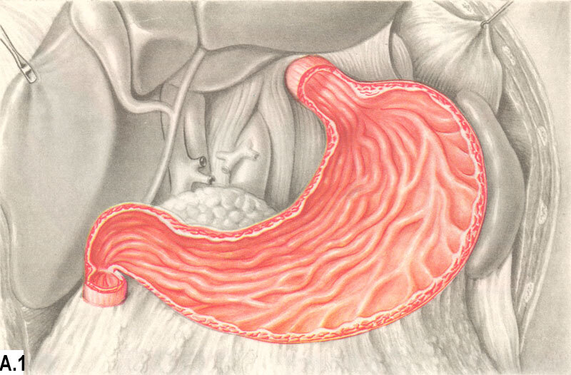 Слизистая оболочка 12 кишки. Острый катаральный гастрит. Пенетрация язвы желудка.
