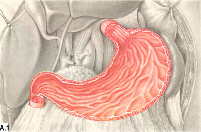 Желудок картины. Острый катаральный гастрит. Катаральный гастрит пилорит. Хронический катаральный гастрит.