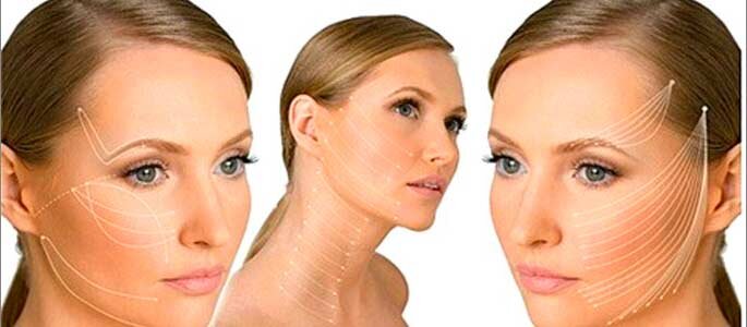 Нитевой лифтинг( армирование)