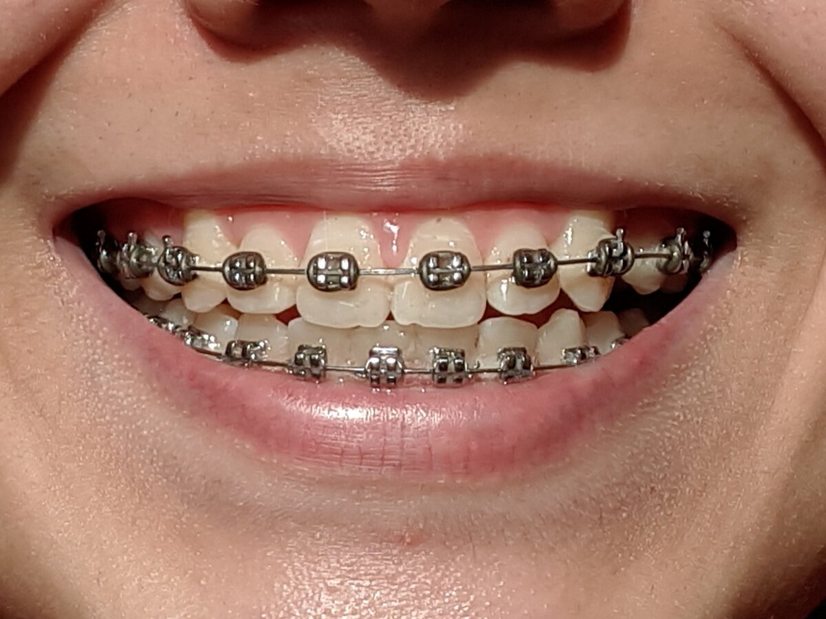 Мои зубы спустя 1,5 года