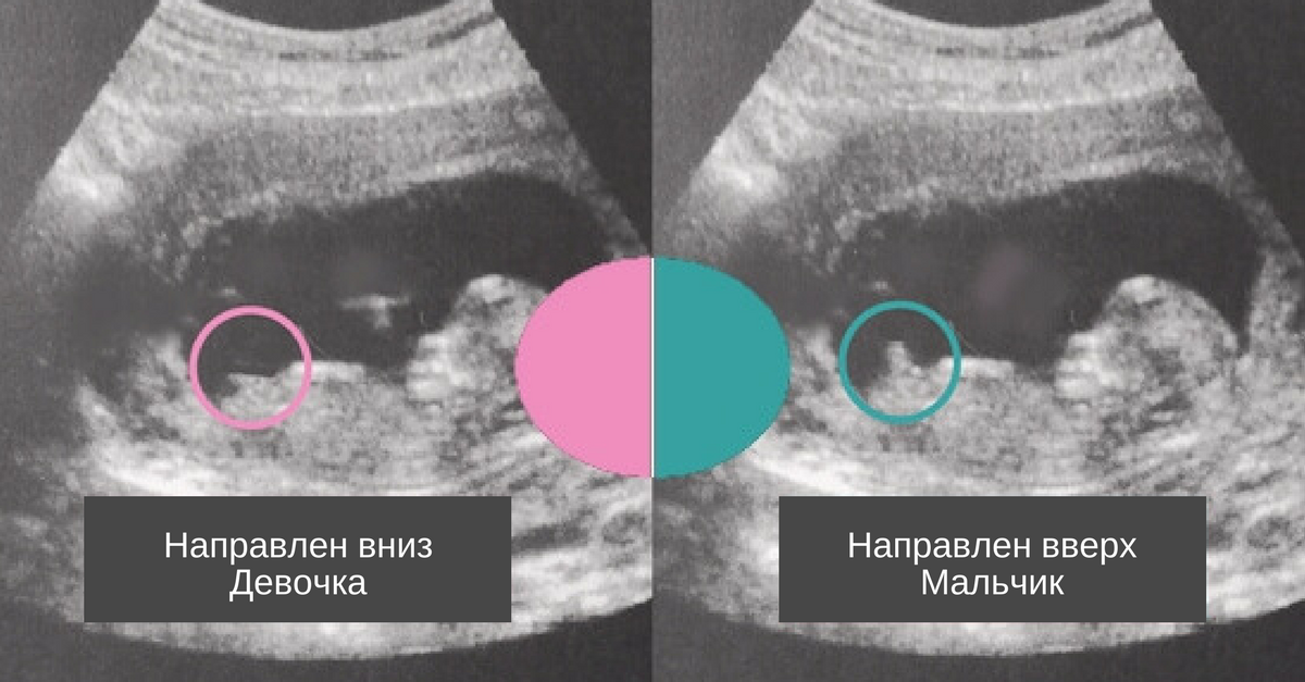 Мальчик или девочка? Определение пола на 12-13 неделе беременности (фото-сравнение полов по узи)
