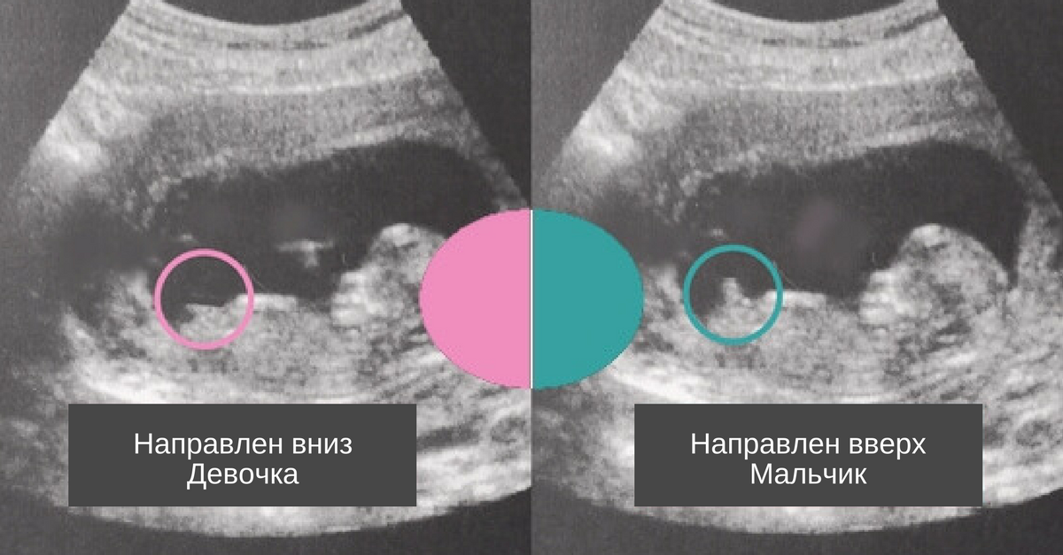 Пол ребенка узи на каком сроке. Пол ребенка на УЗИ. Пол ребёнка в 12 недель на УЗИ. Половой бугорок на УЗИ. Снимки УЗИ С определением пола.