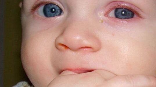 Гноятся глаза у ребенка - причины, лечение и профилактика заболеваний