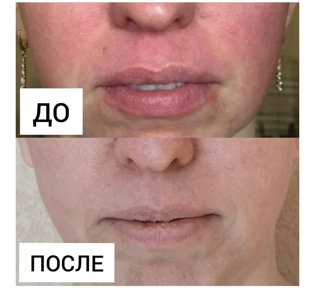Результаты До и После