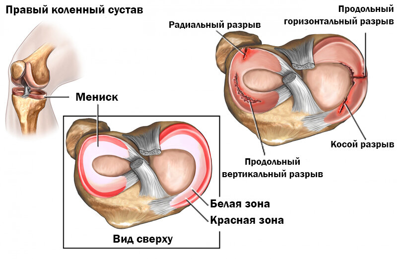 Разрыв мениска картинки