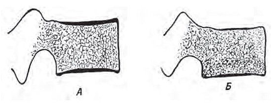 Груботяжистая структура тела поясничного позвонка у штангиста (А). Мелкоячеистая структура тела поясничного позвонка у пловца (Б) (Из книги А.И.Кураченкова «Изменения костно-суставного аппарата у юных спортсменов», М., ФиС, 1958).
