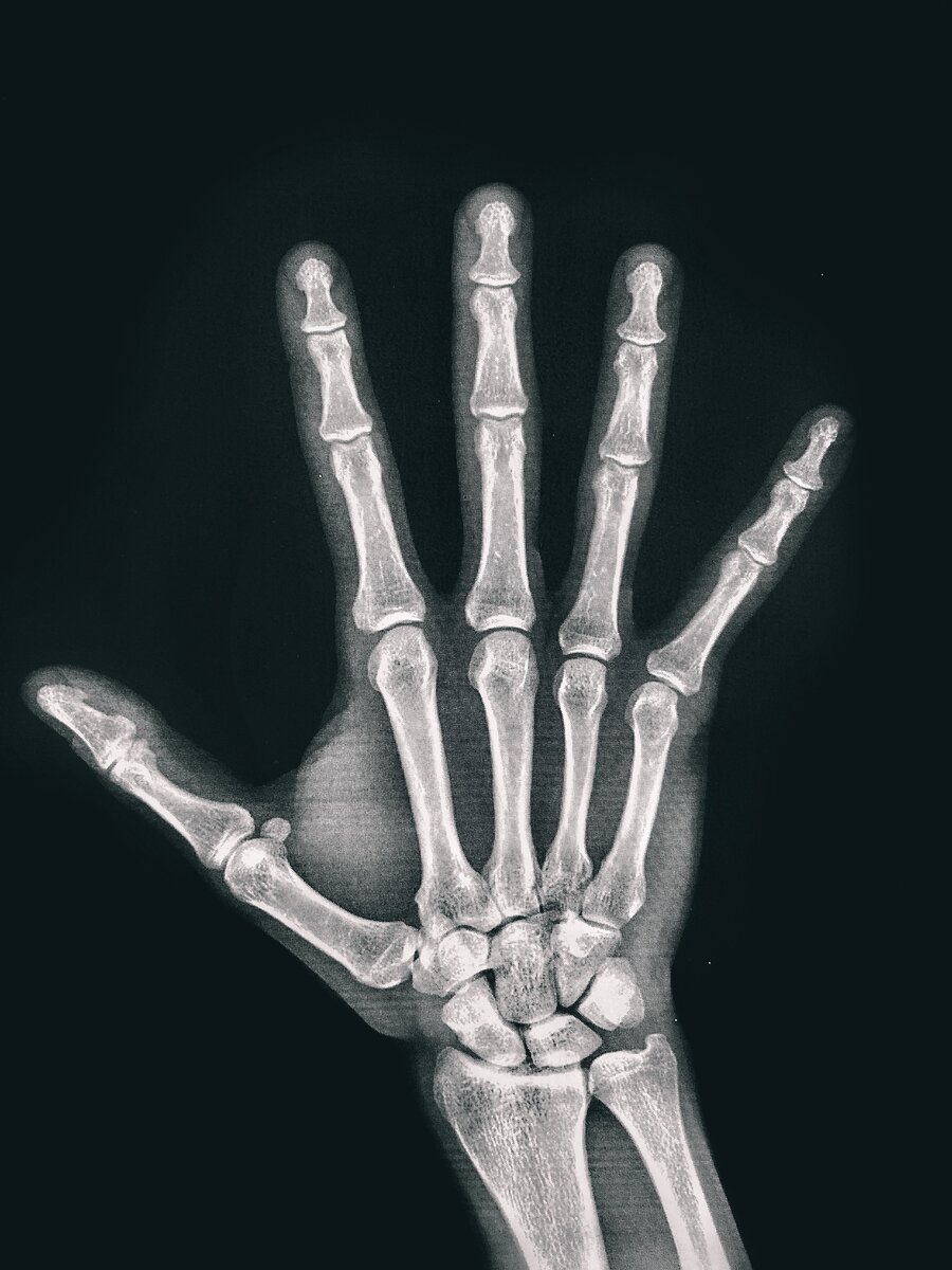 Рентген. Угадайте, какой из 5 пальцев стал вдруг "щелкающим"?
