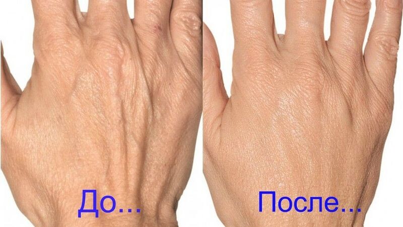 
Руки очень уязвимая часть тела. Женщинам все время приходится подвергать кожу рук к воздействию различных химикатов и моющих средств, при уборке дома или мытье посуды. Отсюда и вытекает множество проблем, кожа рук начинает шелушиться от сухости, появляются трещины, пигментные пятна.