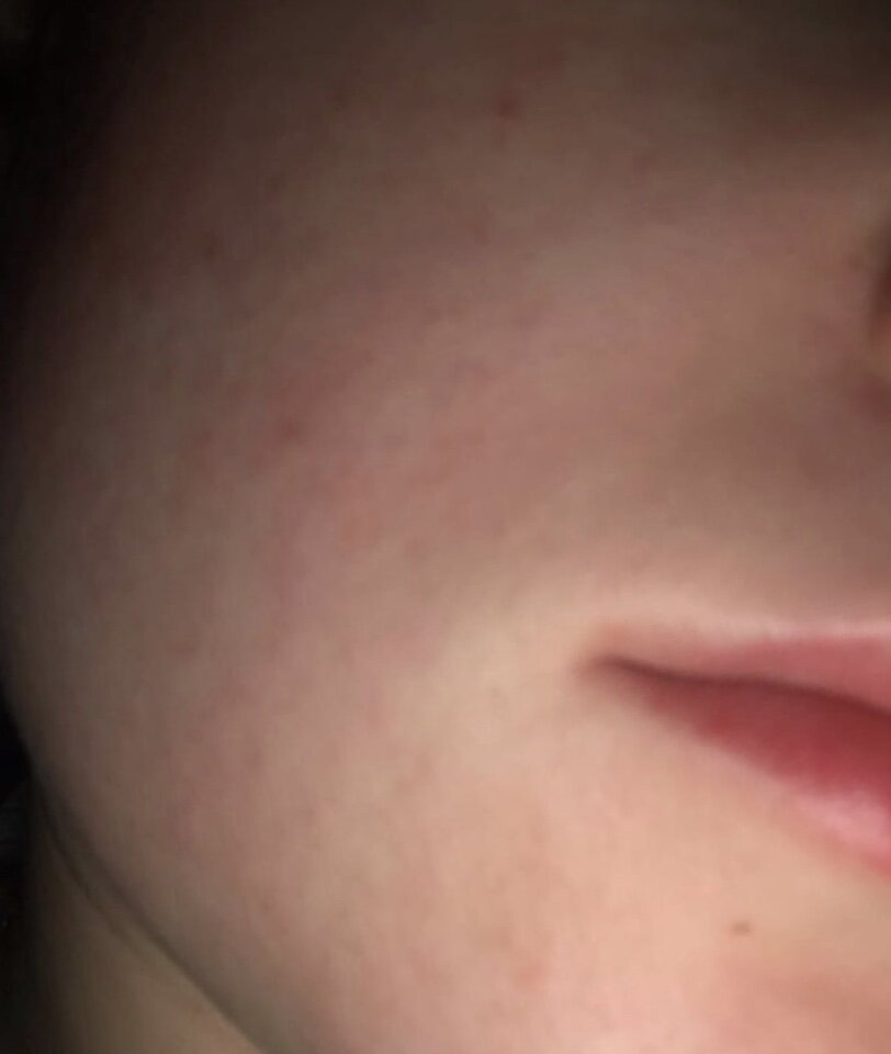 Пожалуйста, без негатива. Первоначальная реакция кожи на эффезел. 