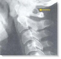 Пример того, как аномалия (синдром) Киммерли выглядит на рентгеновском снимке