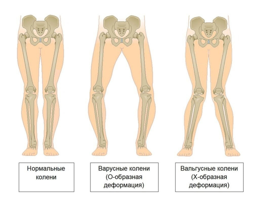 Какая нога. Варусная деформация коленных суставов степени. Вальгусная варусная деформация сустава. Вальгуснаяеформация коленных суставов. Вальгус Варус анатомия.