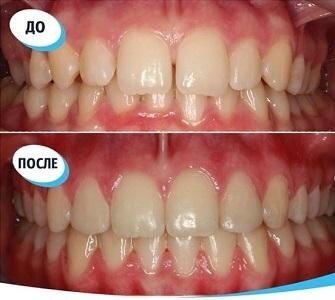 Пример исправления глубокого прикуса и диастемы