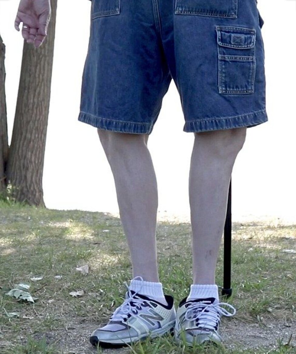 Выворачивает ноги что это. Выворачивает ноги что это. Ноги школьника. Выворачивает ноги что это. Стопа выворачивается наружу.